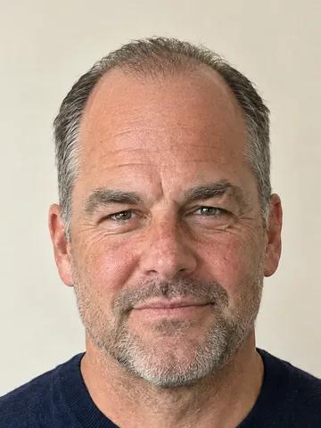 A man with a receding hairline, advanced stage
