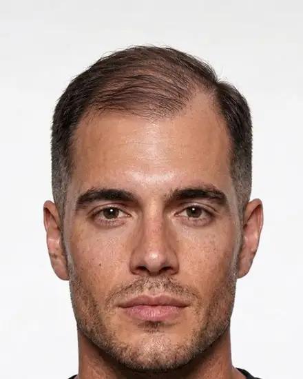 A man with thinning hair, the scalp showing through on top and at the temples